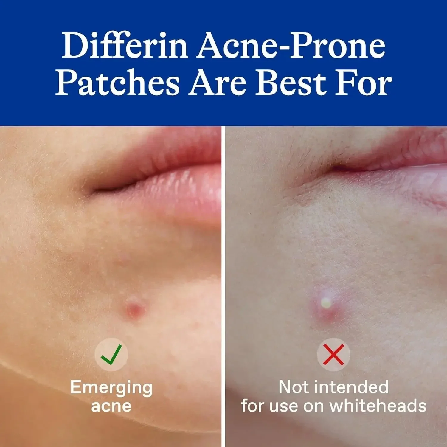 Differin Acne Patches, Pimple Patches for Acne Prone Skin, Formulated with Salicylic Acid and Centella, Fast Triple Action Power Patch for Day & Night, Dermatologist Tested, 36 Count - Image 5