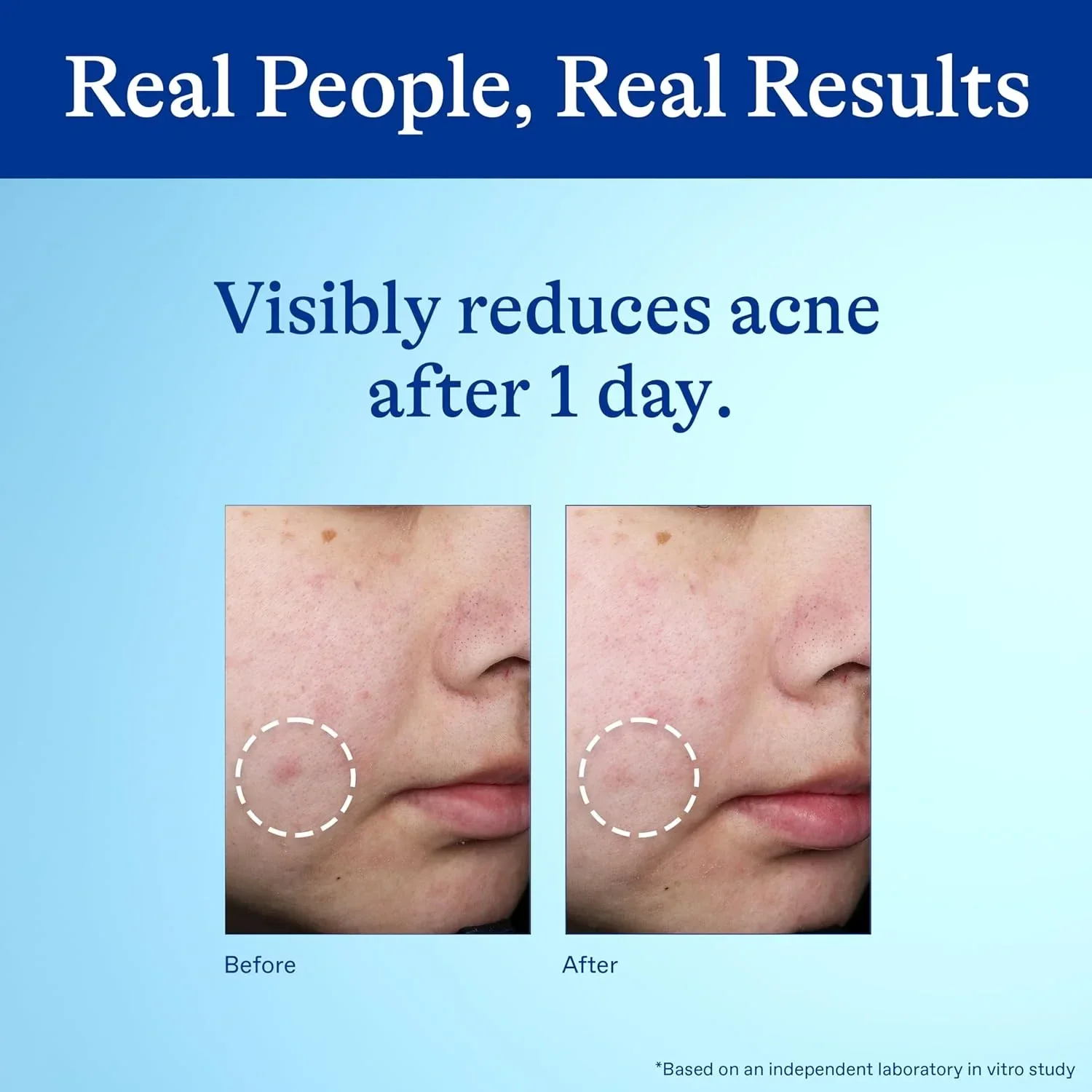 Differin Acne Spot Treatment 10% Benzoyl Peroxide 1 oz - Image 10