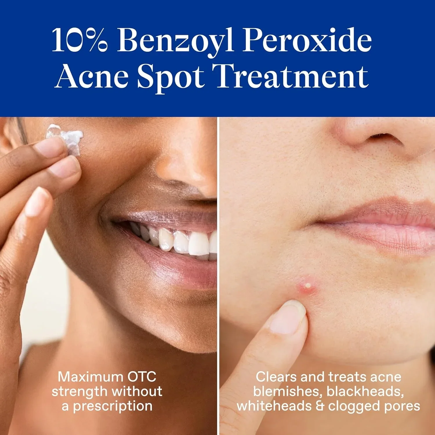Differin Acne Spot Treatment 10% Benzoyl Peroxide 1 oz - Image 6