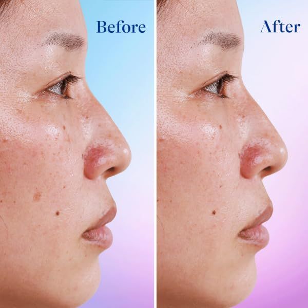 Differin Dark Spot Correcting Face Serum, Dark Spot Correcting Serum by the makers of Differin Gel, Gentle Skin Care for Acne Prone Sensitive Skin, 1 oz (Packaging May Vary) - Image 3
