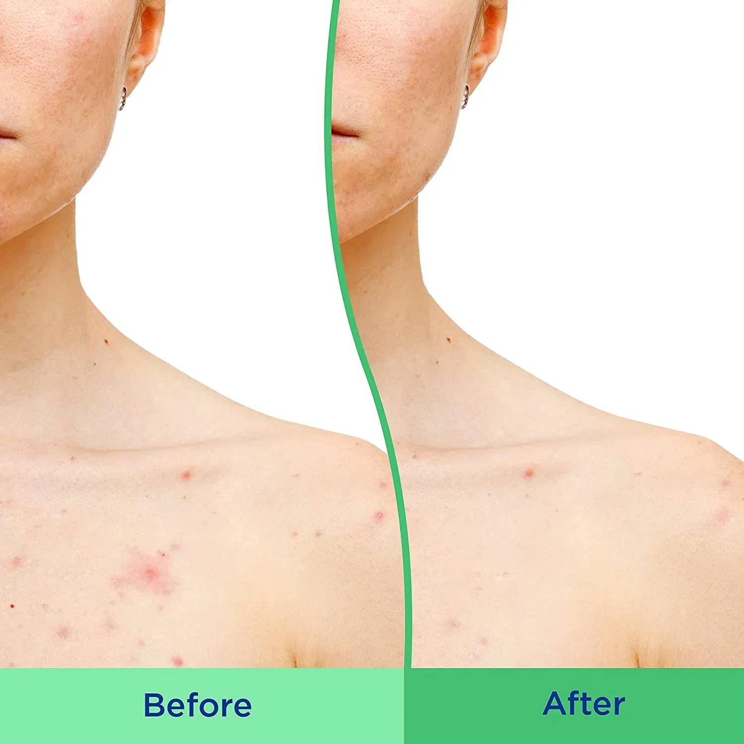 Differin Body Scrub with Salicylic Acid Acne Clearing Improves Tone and Texture Prone Skin on Back Shoulders and Chest, 8 Oz (Packaging May Vary) - Image 7