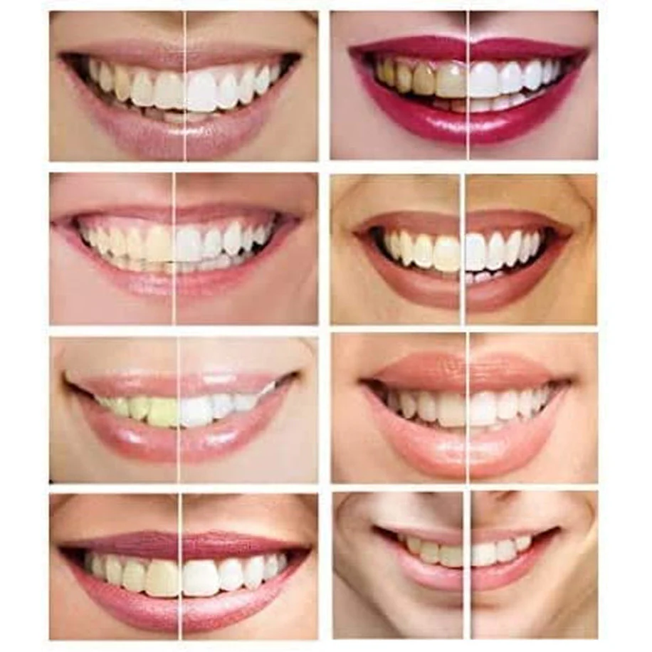 White Teeth Global Teeth Whitening Gel 44% Carbamide Peroxide 6 x 3ml Syringes - Image 4
